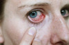 Инфекции глаз