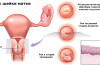 Рак шейки матки лечение
