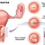 Рак шейки матки лечение