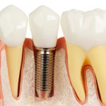 Протезирование зубов имплантация
