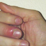 Панариций пальца на руке