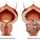 Аденома предстательной железы