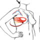 коррекция асимметрии груди
