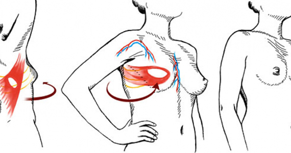 коррекция асимметрии груди