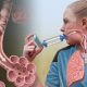 Лечение аллергической астмы