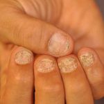псориатический артрит ногти