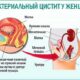 Цистит – воспаление слизистой оболочки мочевого пузыря