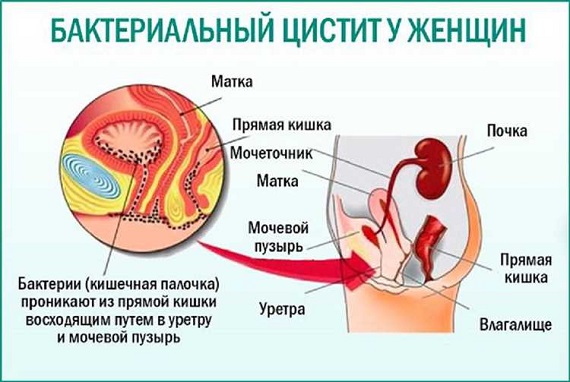 Цистит – воспаление слизистой оболочки мочевого пузыря