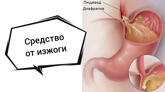 Методы лечения изжоги Методы лечения изжоги