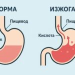 Причины вознекновения изжоги