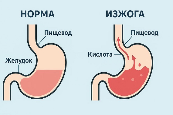 Причины вознекновения изжоги Причины вознекновения изжоги
