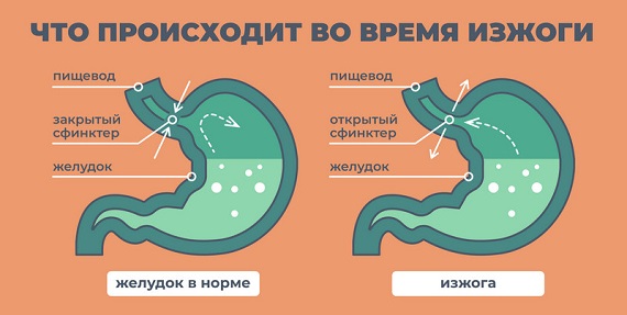 симптомы изжоги