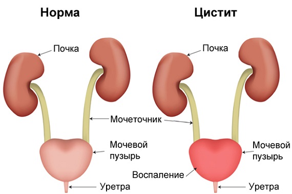 Какие признаки цистита? Какие признаки цистита?